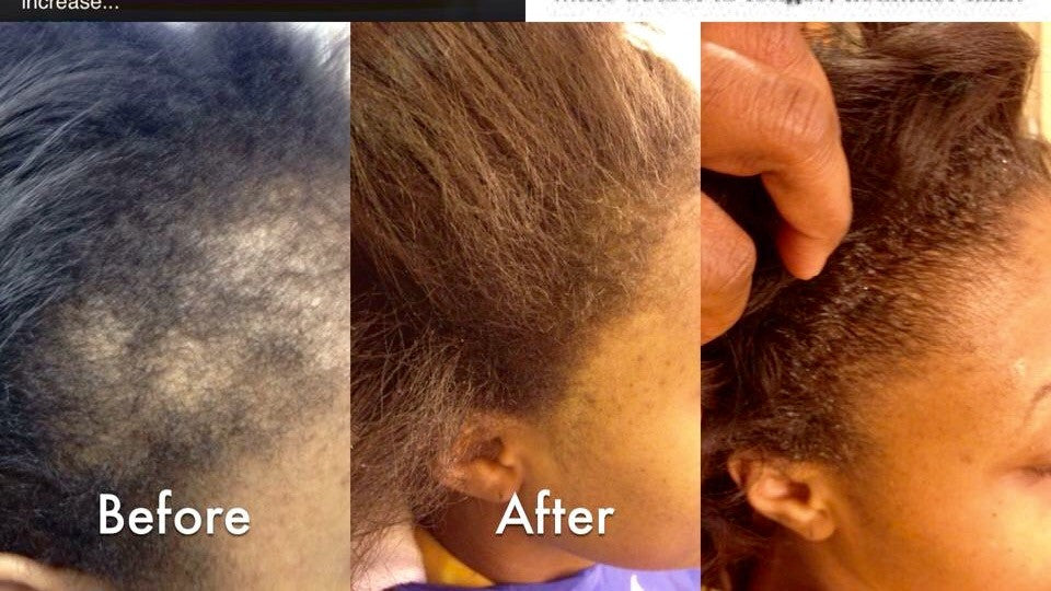 Stimulating Hair Growth System